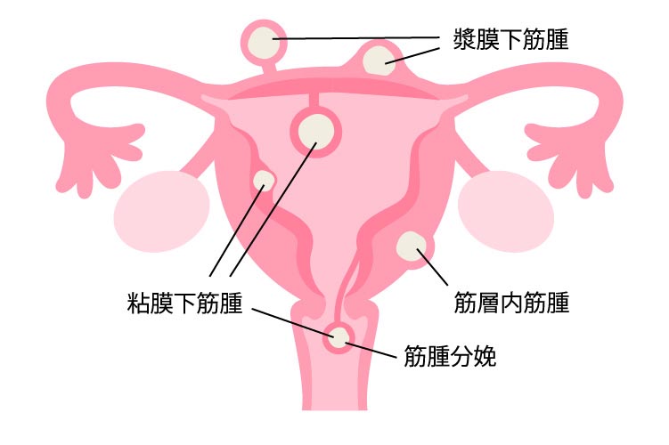 子宮筋腫のイメージ画像