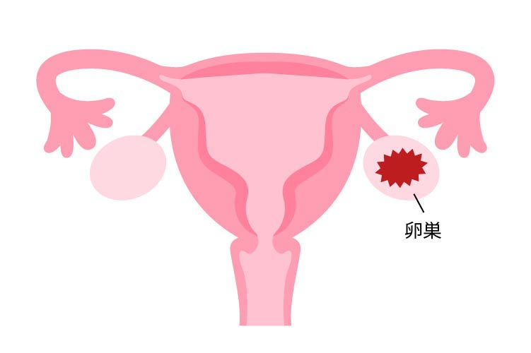 卵巣腫瘍のイメージ画像